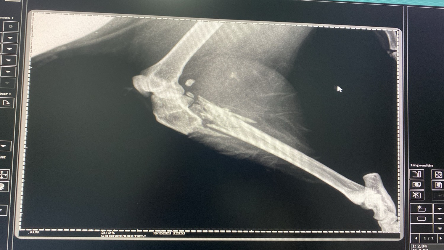 Radiografía de una fractura